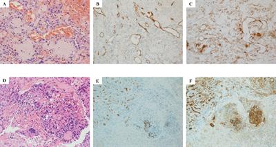 Case report: Unique FLT4 variants associated with differential response to anlotinib in angiosarcoma